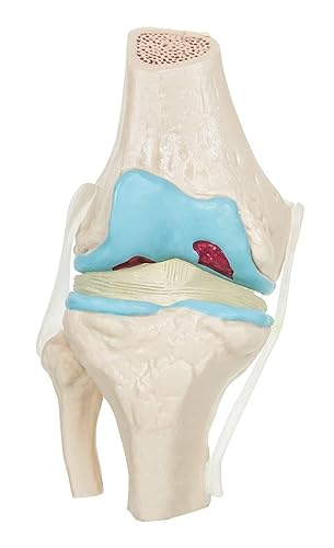 4 Stage Osteoarthritis Anatomical Knee Model, Model On Base, with Detailed Study