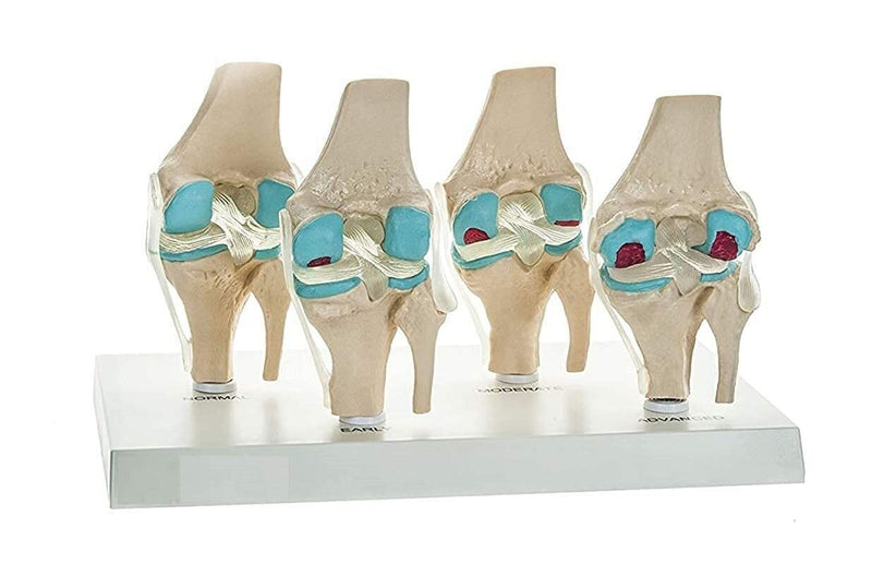 Spancare 4 Stage Osteoarthritis Anatomical Knee Model, Model On Base, with Detailed Study