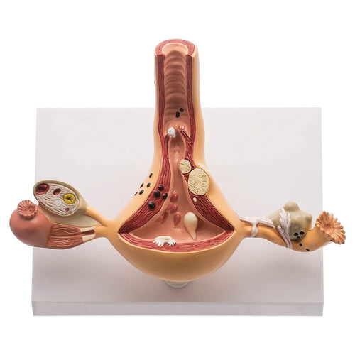 Spancare Ovary and Uterus Female Reproductive Organ Anatomical Model Common Abnormalities
