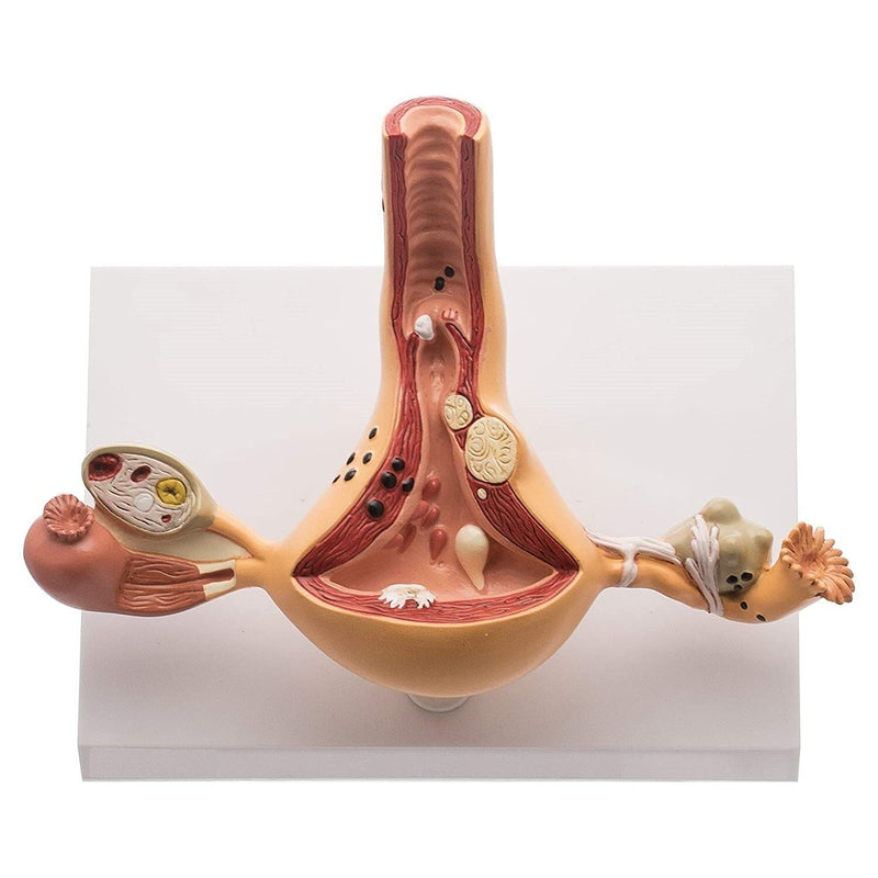 Spancare Ovary and Uterus Female Reproductive Organ Anatomical Model Common Abnormalities