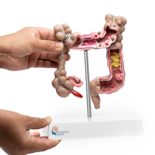 Human Intestine Anatomical Model With Pathologies Premium Quality